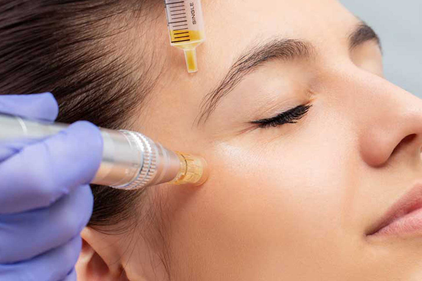 PRP with Microneedling