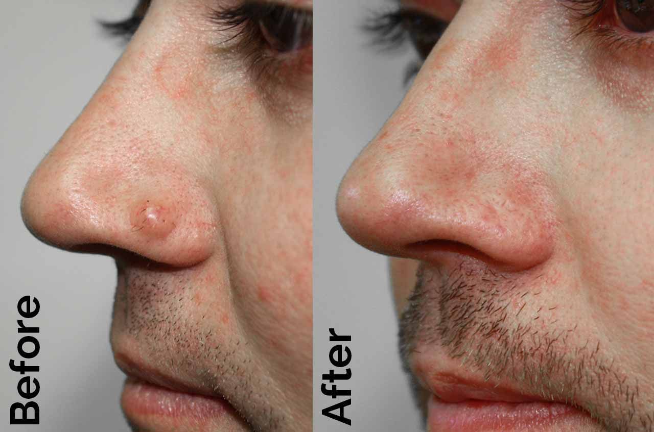 Wart Removal (Single)
