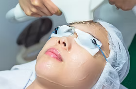 IPL Acne Control