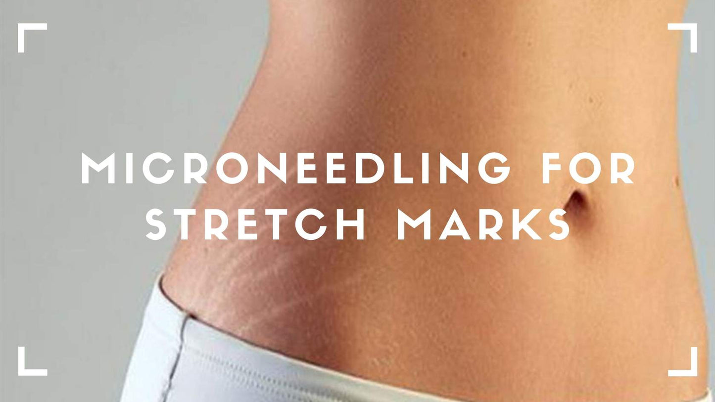 Morpheus8 Stretch Mark Removal