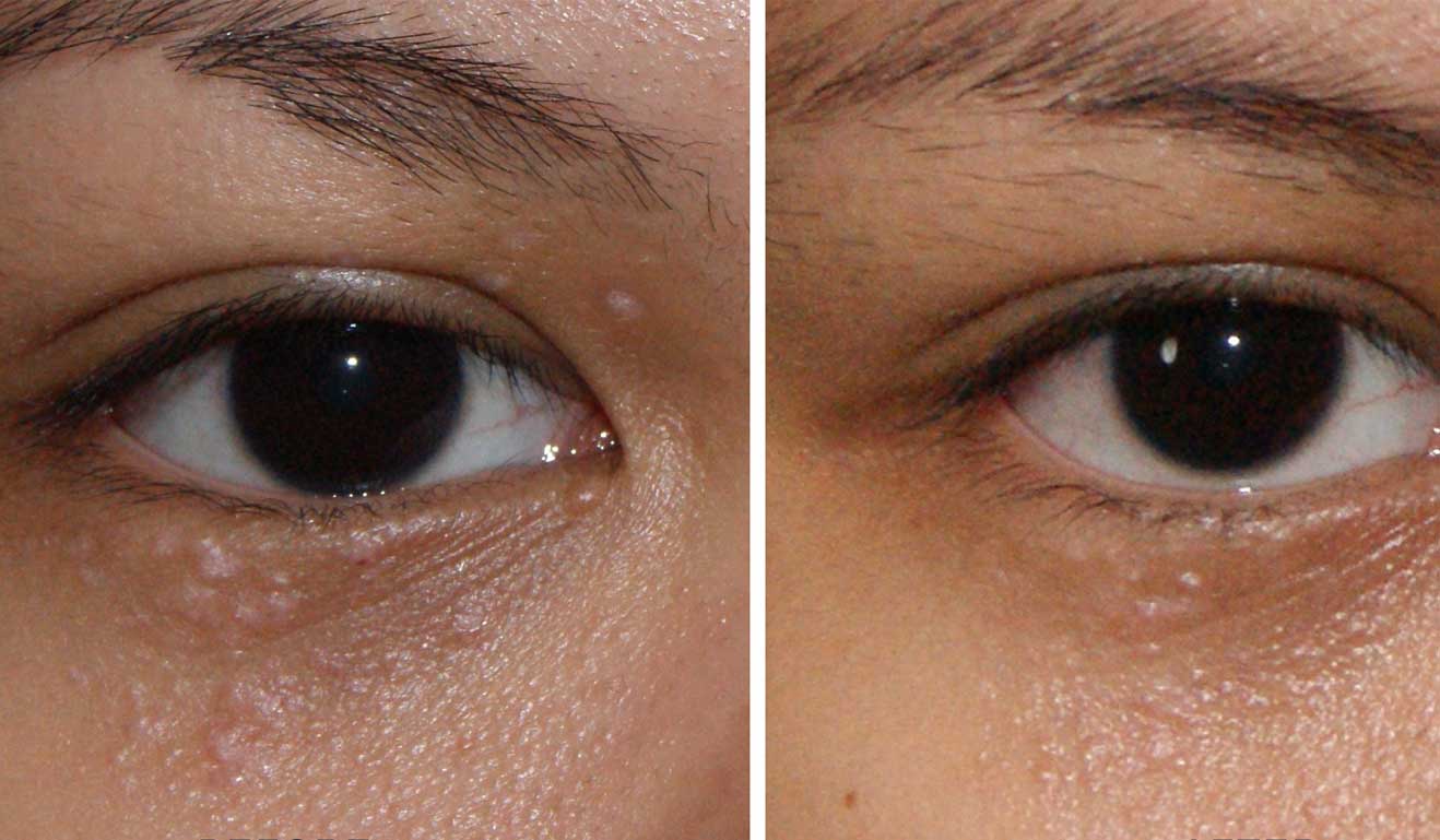 Siringoma Plasma Removal