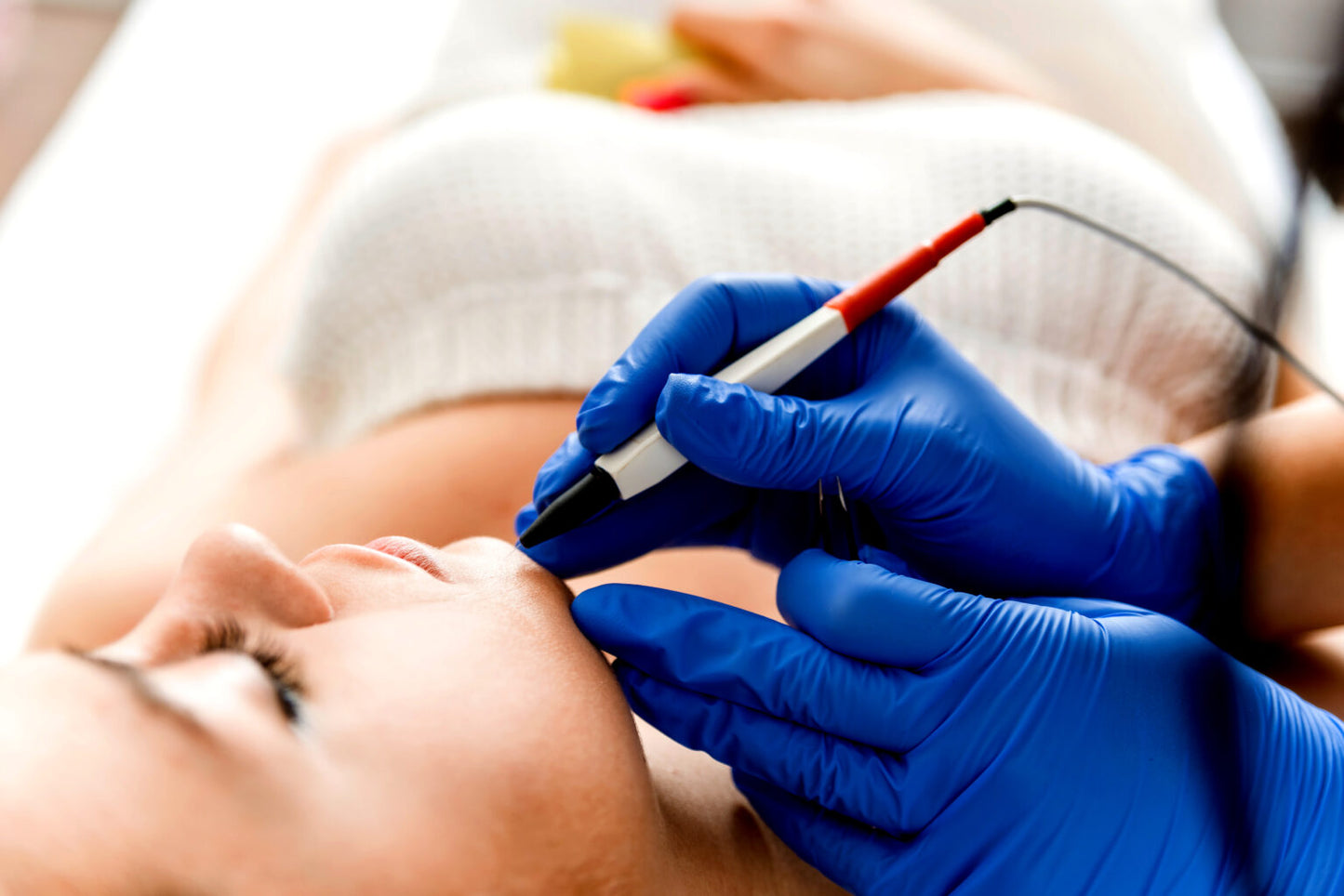 Electrolysis Blood Spots Removal